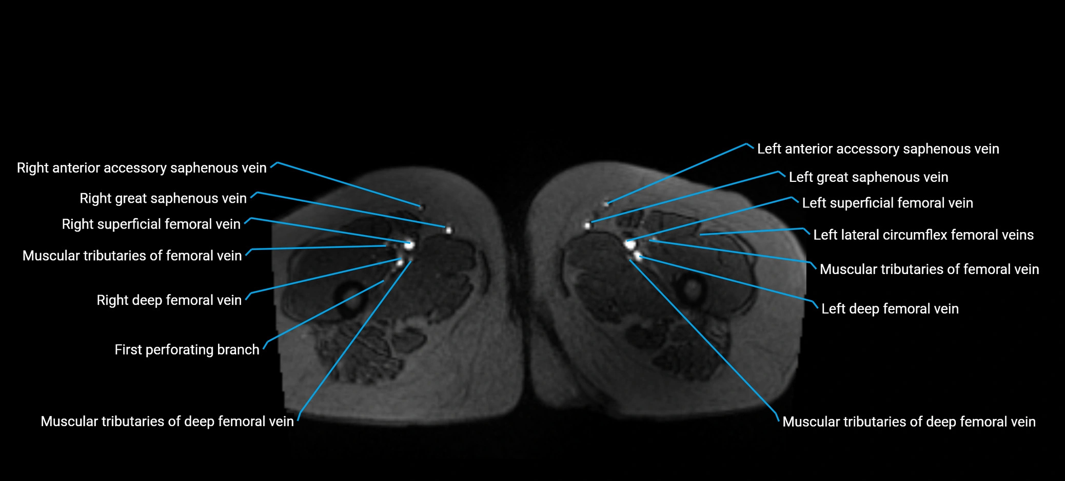 MRV abdomen pelvis & lower limb axial cross sectional anatomy labelled MRI image 221 (1).webp